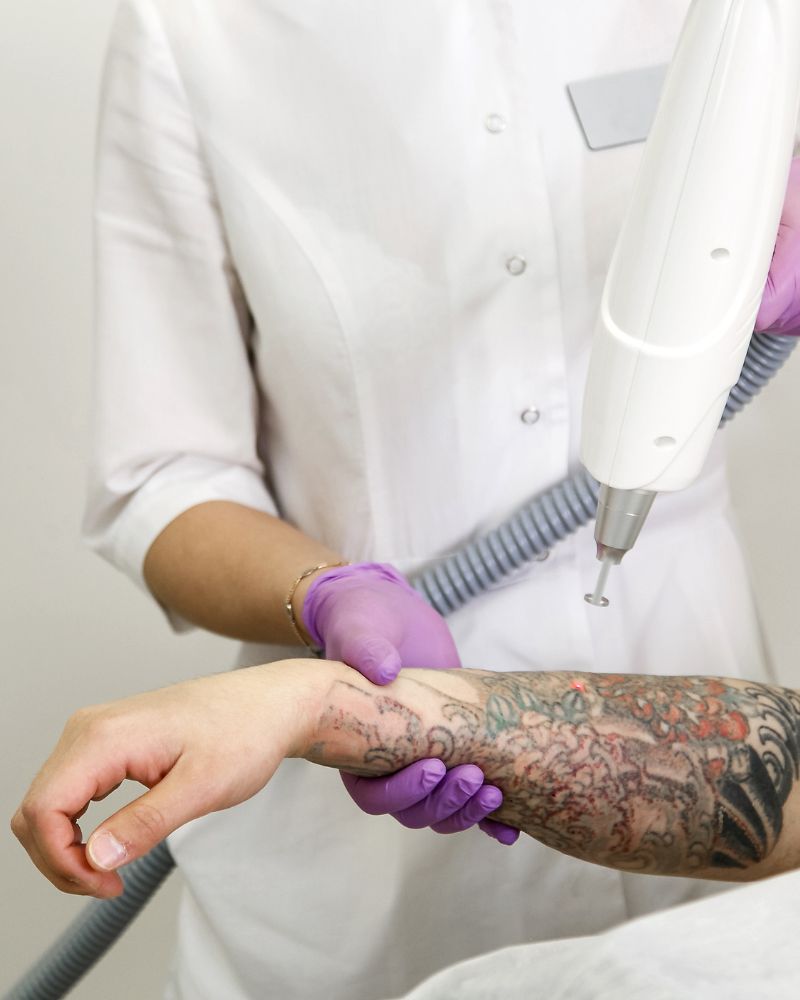 Laser Tattoo Removal Treatment