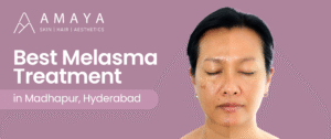 Best Melasma Treatment in Madhapur