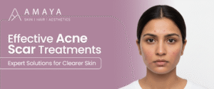 Acne scar treatments in Hyderabad