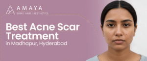 Best acne scar treatment in madhapur