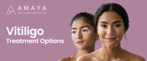Vitiligo Treatment